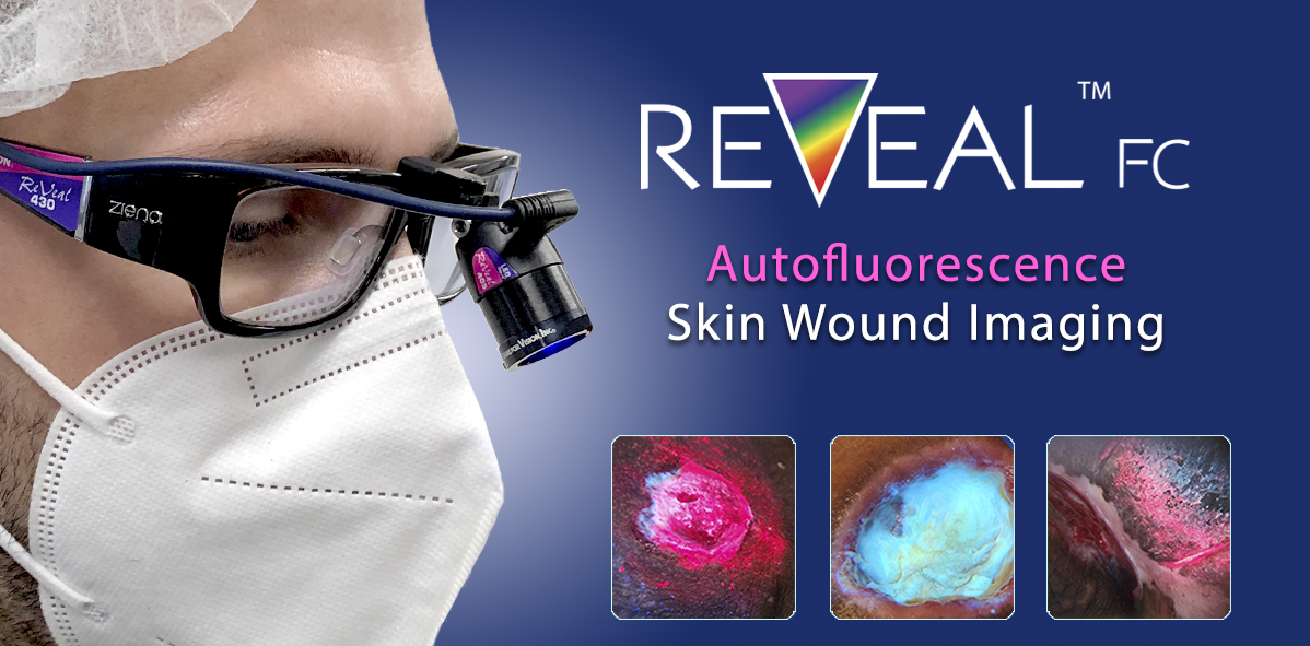 REVEAL Autofluorescence Wound Imaging